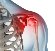 About hydrodilatation for frozen shoulder